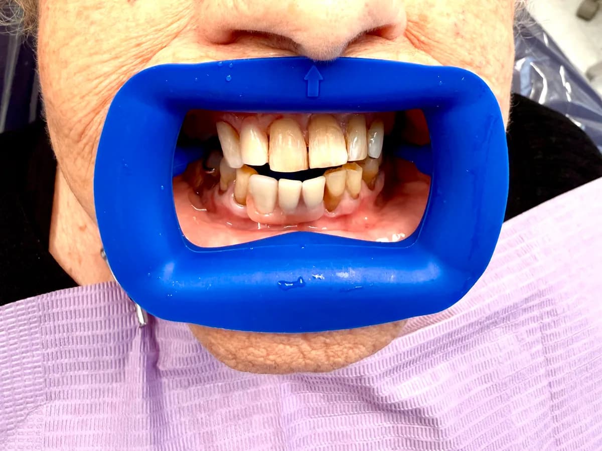 After composite bonding restoring smooth, natural-looking teeth without extensive dental work at Innova Smiles in Marlborough, MA