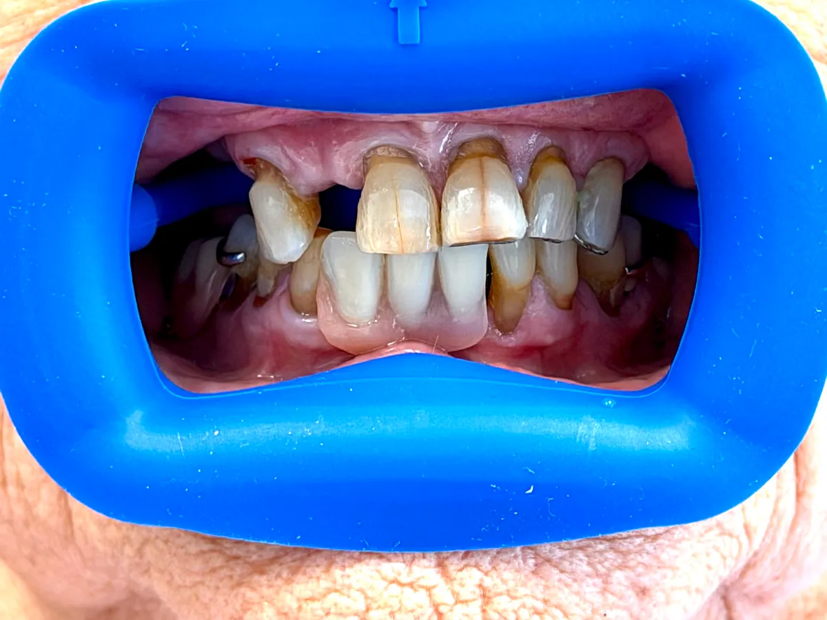 Before conservative bonding for tooth fracture lines and gumline wear at Innova Smiles in Marlborough, MA