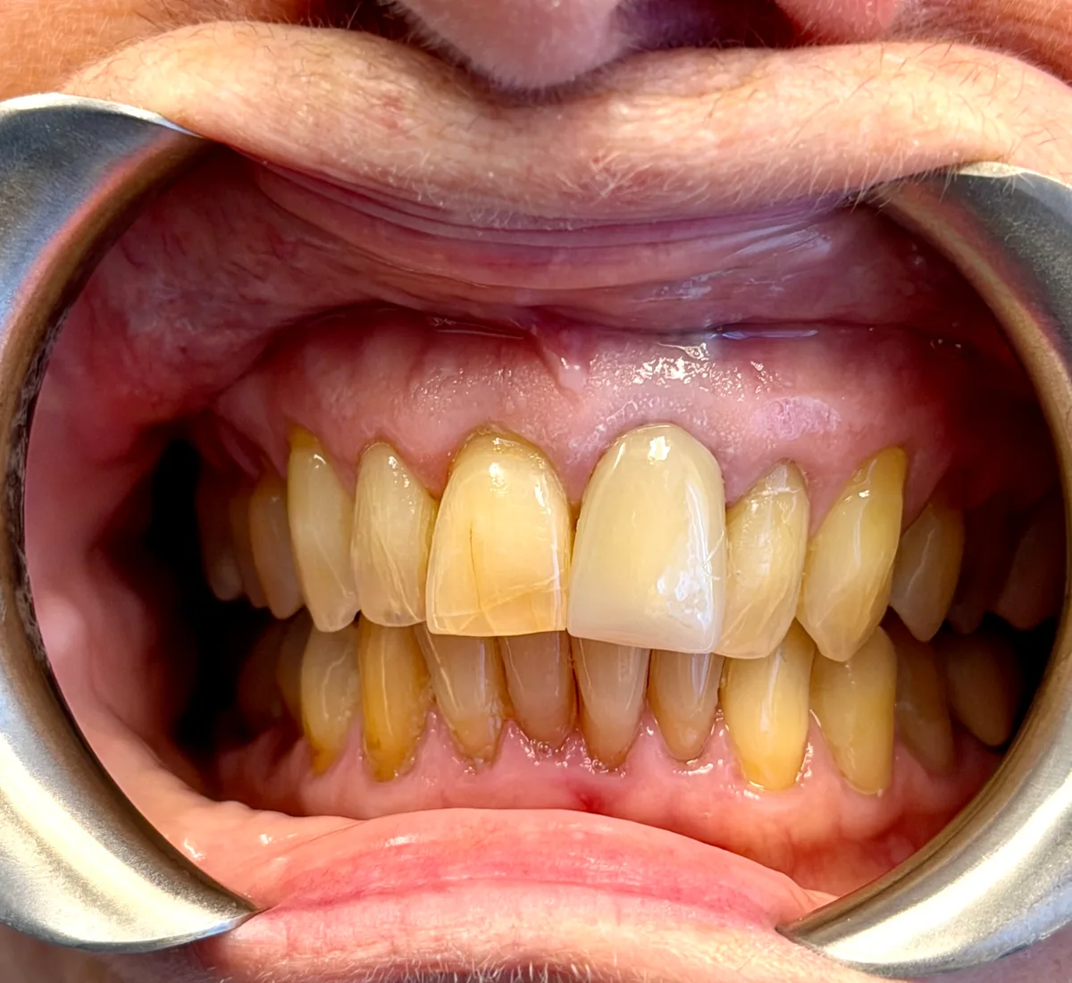 Linda B before two porcelain crowns on her upper front teeth (visible wear and discoloration)