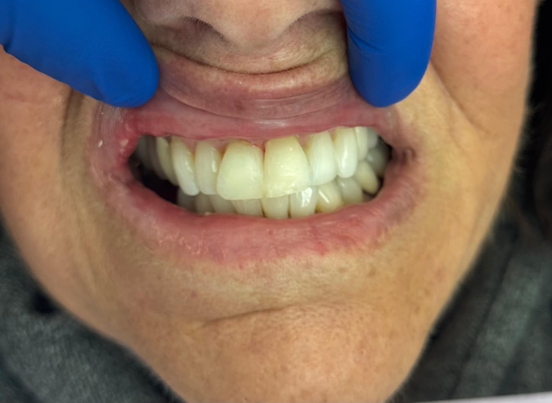 Patient 3 after treatment (seamless gap repair)