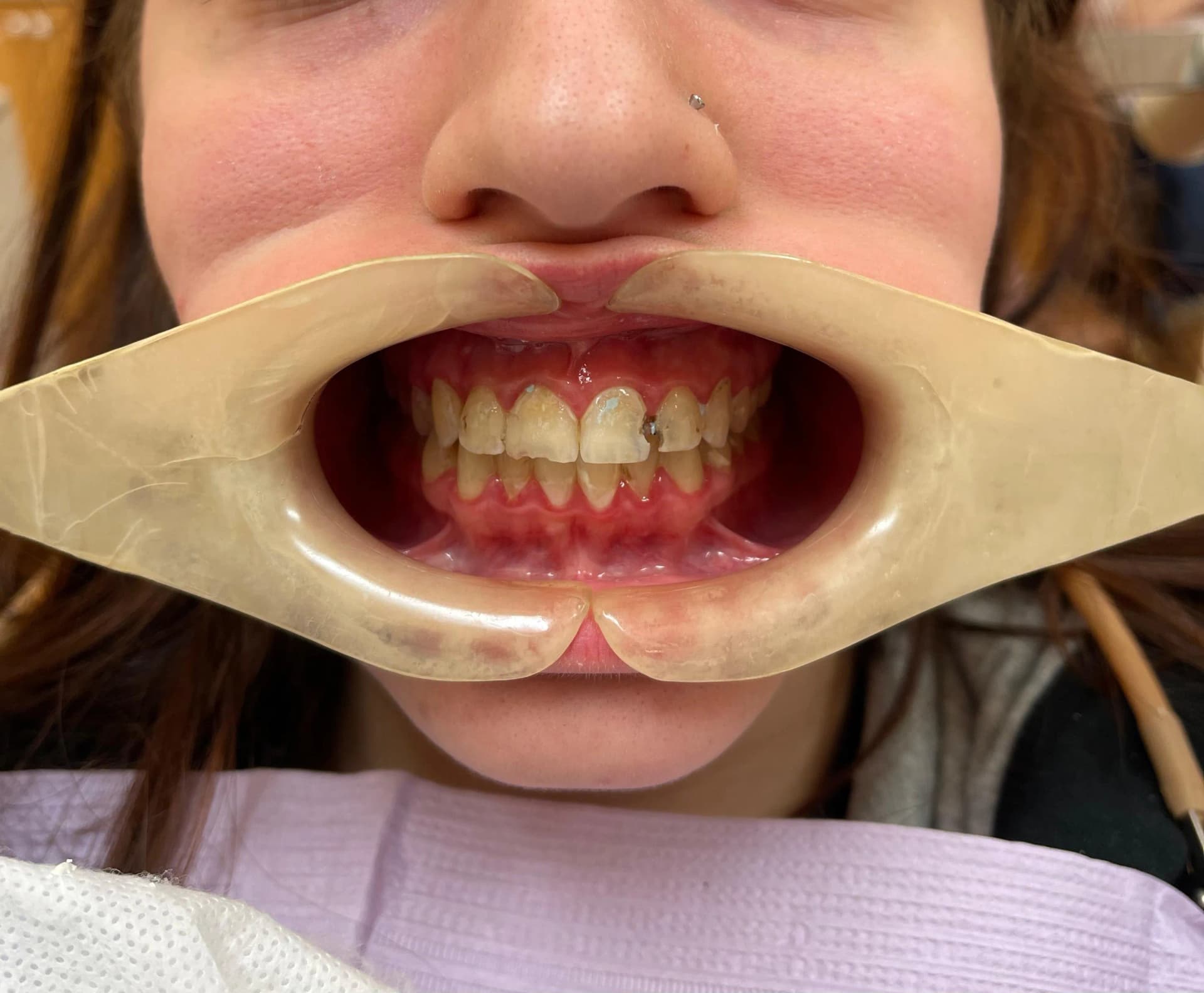 Patient 1 before treatment