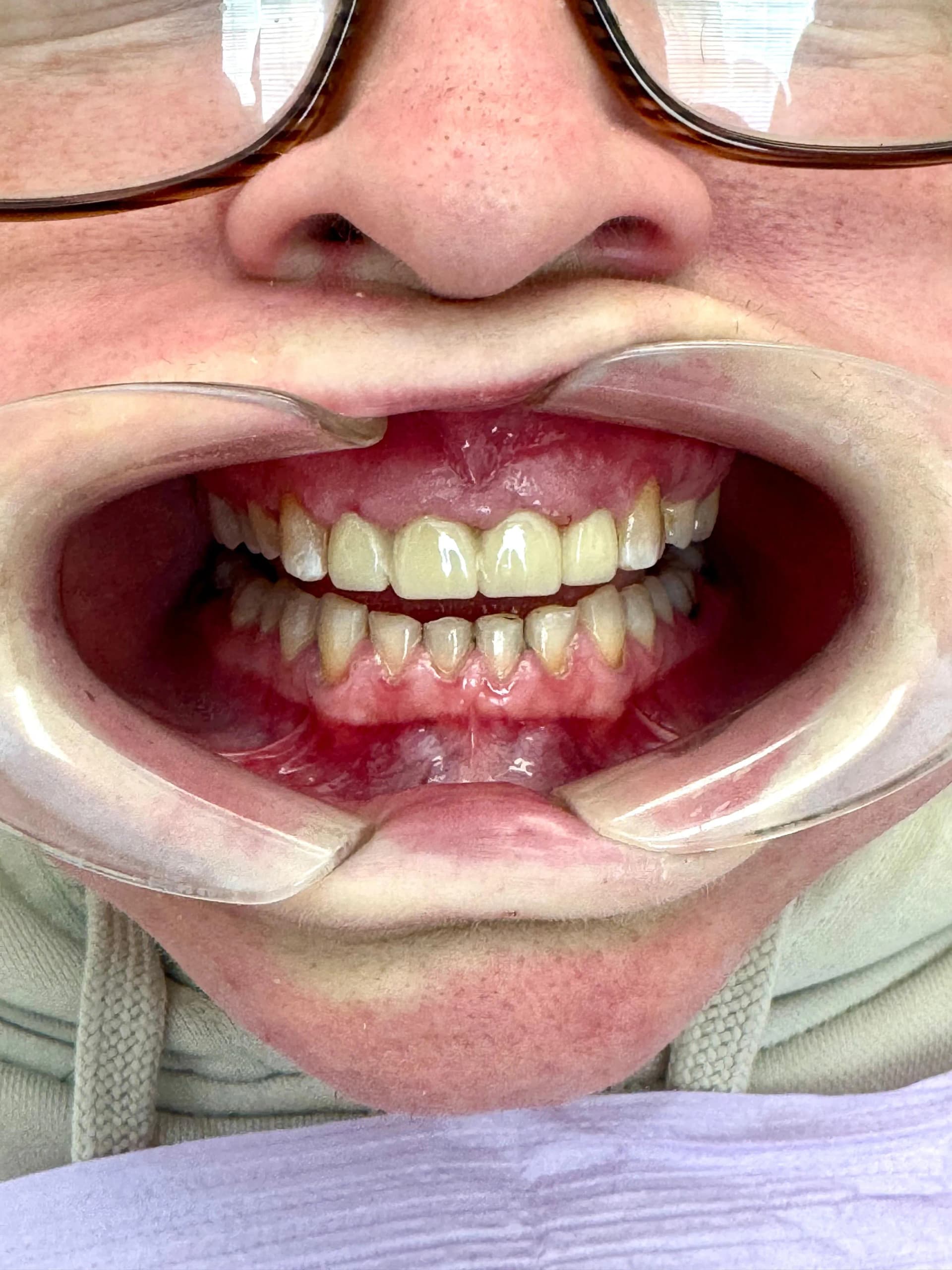 Patient 2 after treatment