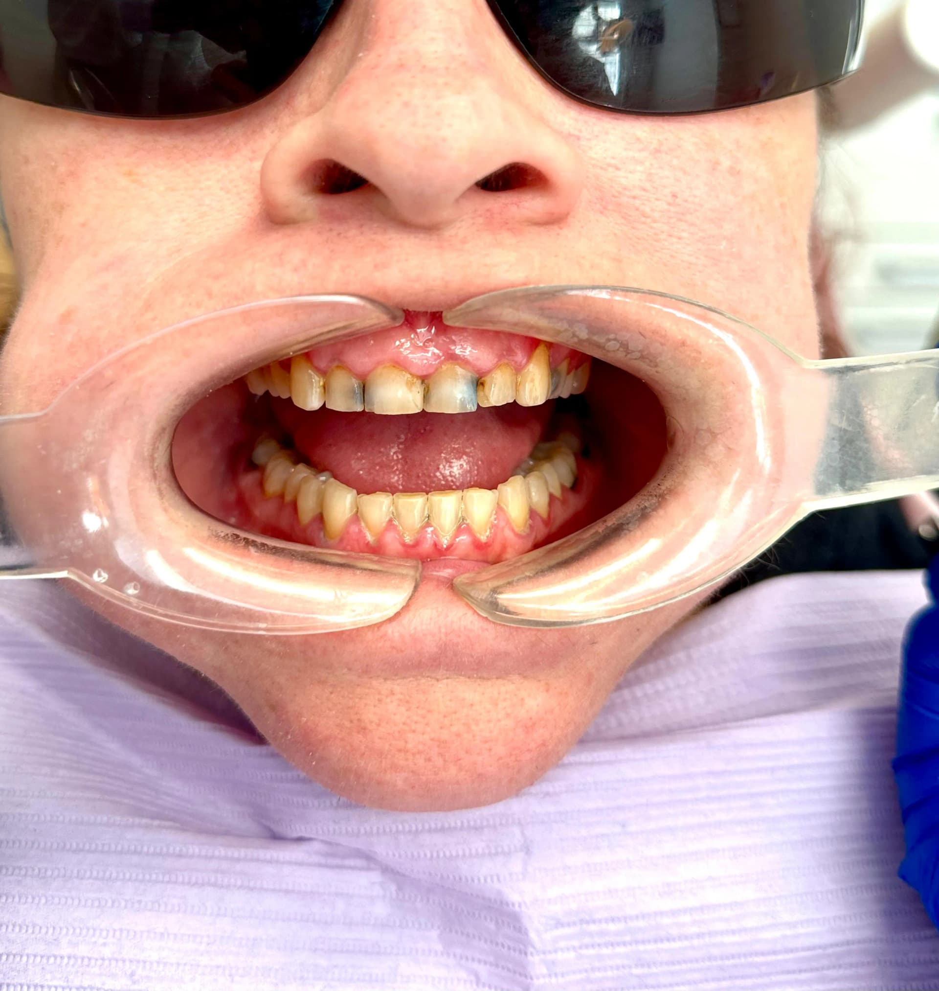 Patient 2 before treatment