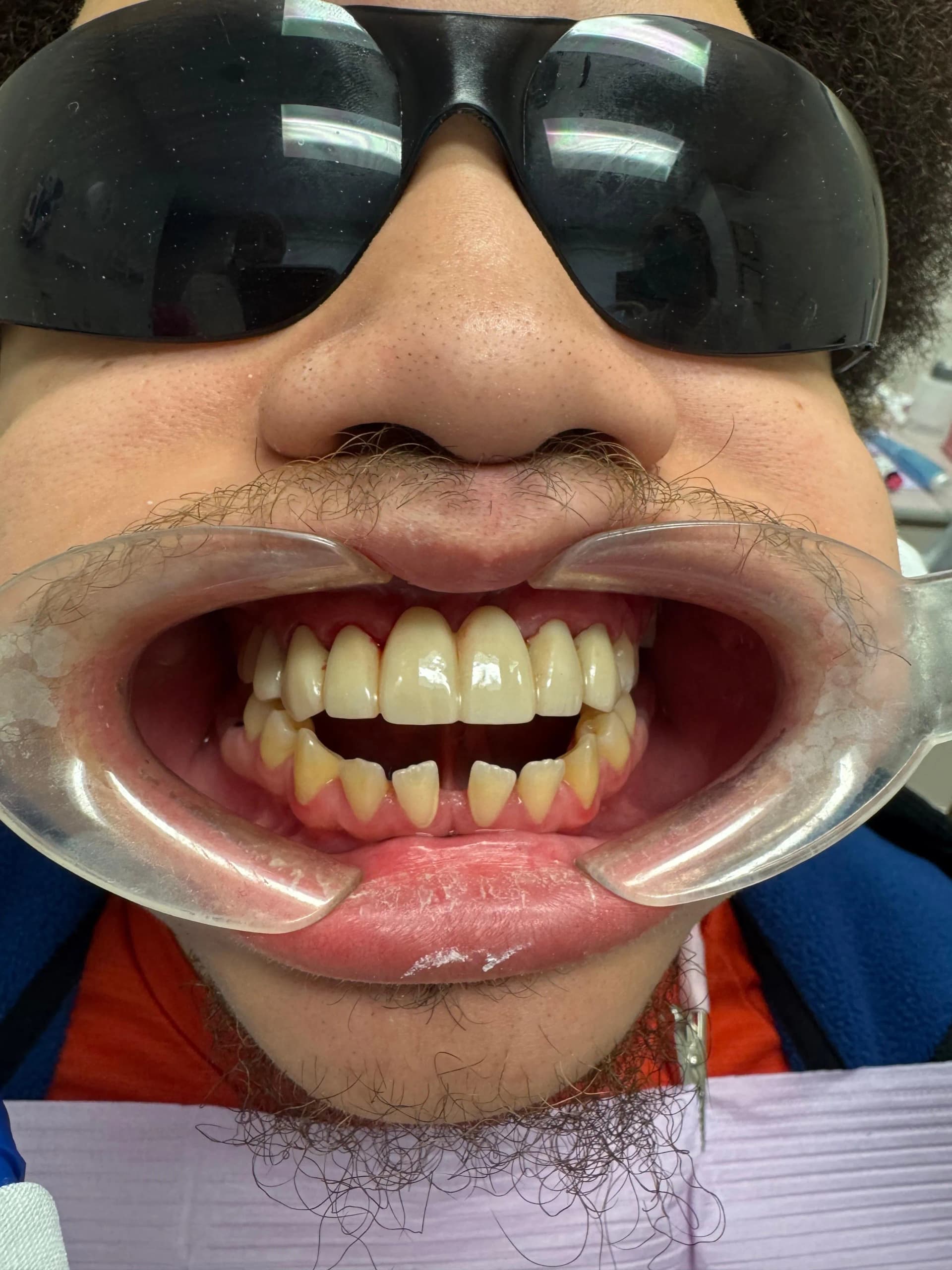 Patient 4 after custom 6-unit bridge (restored smile and function)