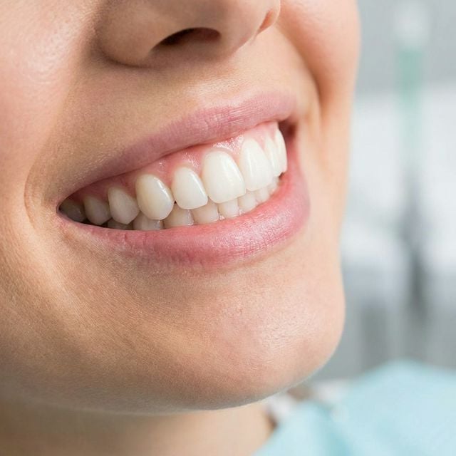 Close up of a perfect smile after cosmetic bonding